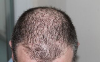 Baldness or hair loss