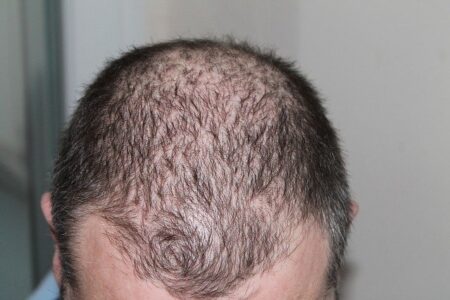 Baldness or hair loss