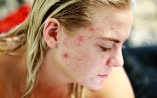 Tips for Acne free skin