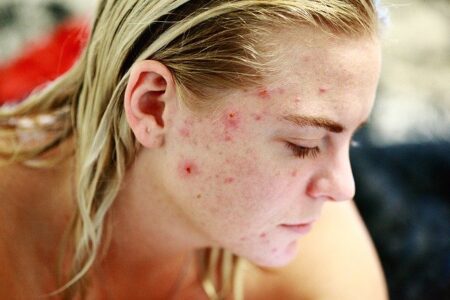 Tips for Acne free skin