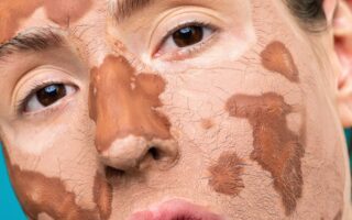 How To Treat Dry Skin On Face