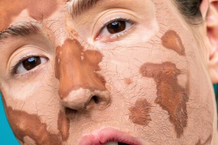 How To Treat Dry Skin On Face