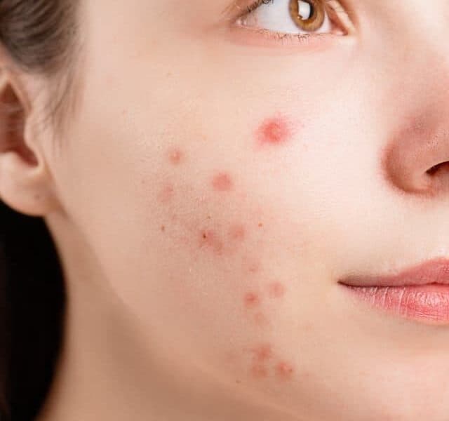 5 tips to reduce acne and scars.