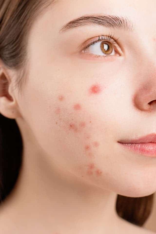 5 tips to reduce acne and scars.