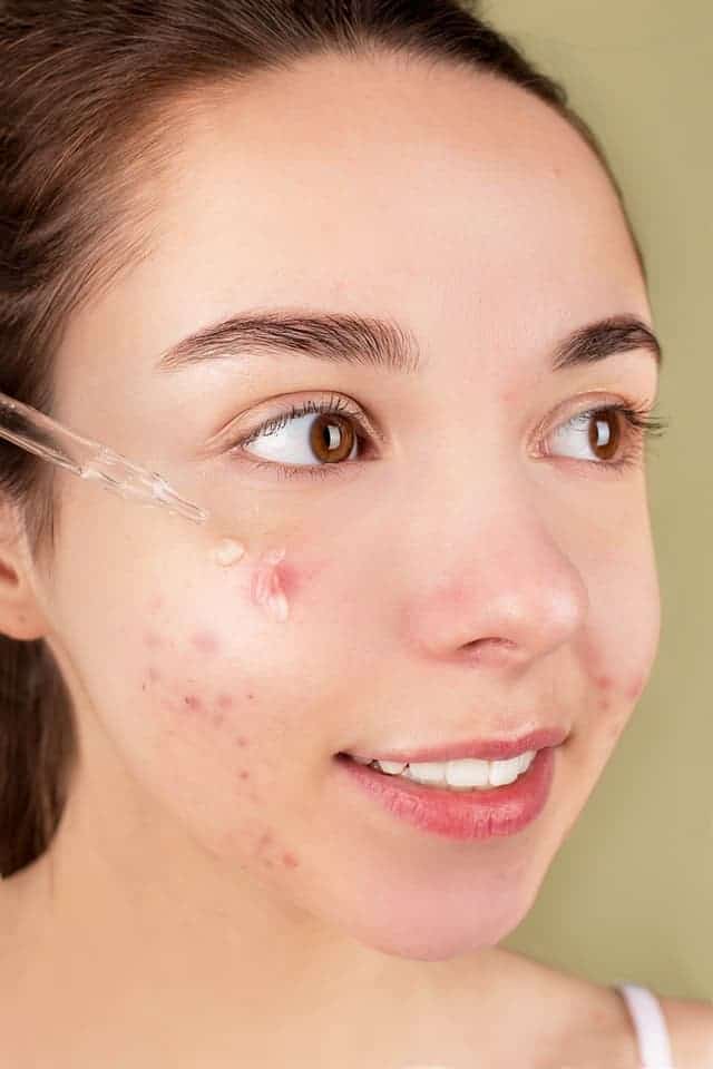 Treating stubborn Acne with Technology