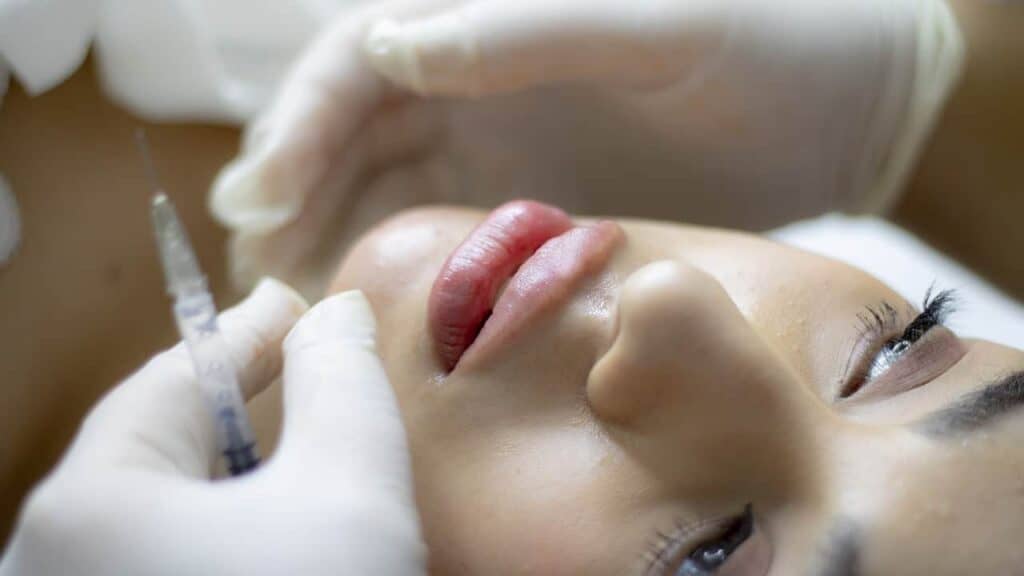 All about lip lift surgery