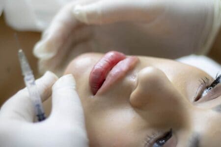 All about lip lift surgery