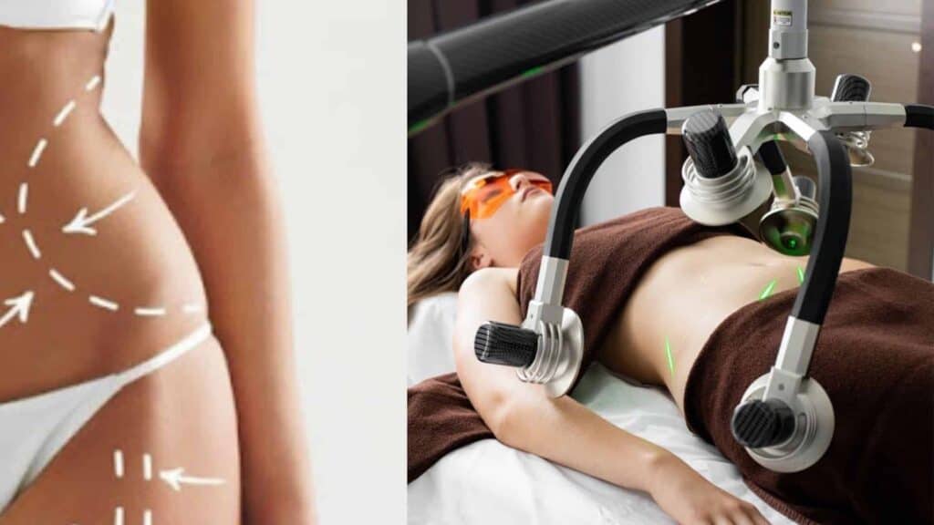 Liposuction - Things you need to know