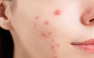 7 Mistakes When Treating Acne